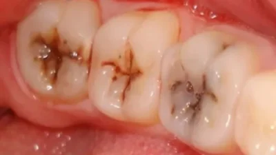 Son yıllarda artan kolalı içecek tüketimi, sağlığımız üzerinde ciddi tehditler